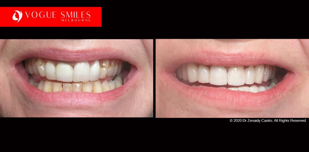 Full Mouth Reconstructions Melbourne Before and After