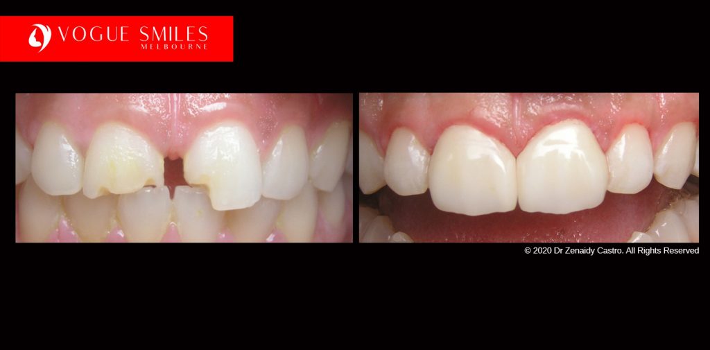 Full Mouth Reconstruction Before and After