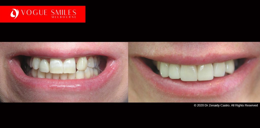 Cosmetic Dentistry Treatment Results Gallery, closeup photos porcelain veneers before and after Melbourne, Affordable Dental Veneers Before and After Melbourne close-up, Vogue Smiles Dental Dentistry Melbourne Studios Clinic Practice