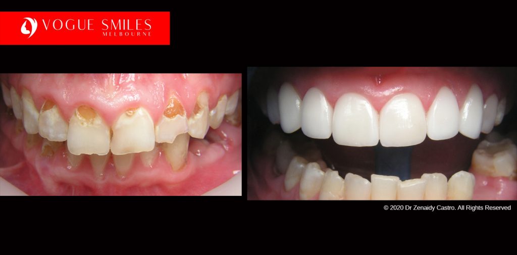 Full Mouth Reconstruction Before and After