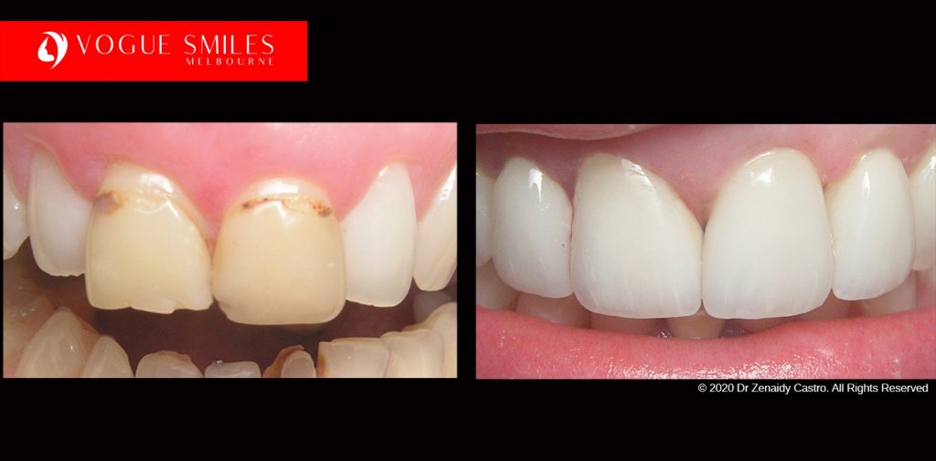 Cosmetic Dentistry Treatment Results Gallery, closeup photos porcelain veneers before and after Melbourne, Affordable Dental Veneers Before and After Melbourne close-up, Vogue Smiles Dental Dentistry Melbourne Studios Clinic Practice