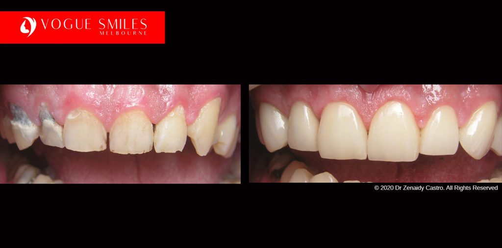 Full Mouth Reconstruction Before and After