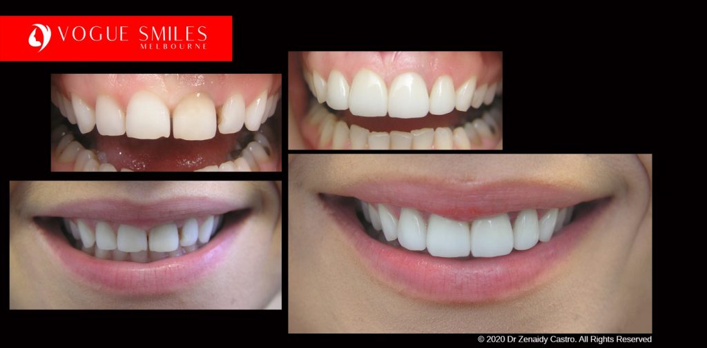 Cosmetic Dentistry Treatment Results Gallery, closeup photos porcelain veneers before and after Melbourne, Affordable Dental Veneers Before and After Melbourne close-up, Vogue Smiles Dental Dentistry Melbourne Studios Clinic Practice