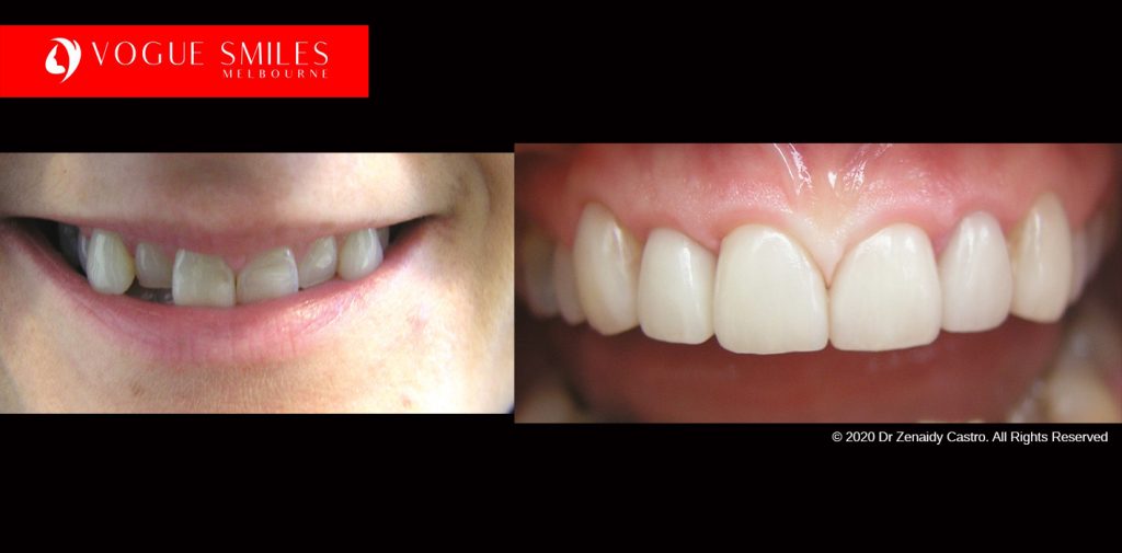 Cosmetic Dentistry Treatment Results Gallery, closeup photos porcelain veneers before and after Melbourne, Affordable Dental Veneers Before and After Melbourne close-up, Vogue Smiles Dental Dentistry Melbourne Studios Clinic Practice