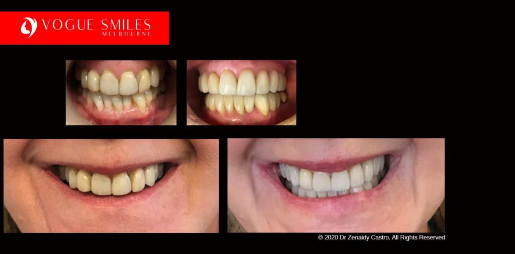 Full Mouth Reconstruction Before and After