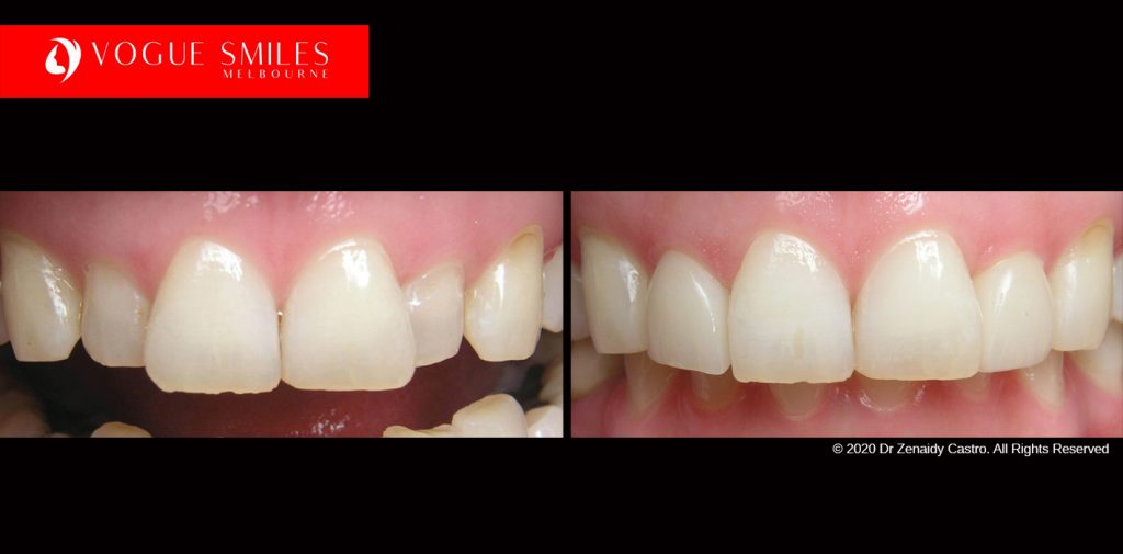 Cosmetic Dentistry Treatment Results Gallery, closeup photos porcelain veneers before and after Melbourne, Affordable Dental Veneers Before and After Melbourne close-up, Vogue Smiles Dental Dentistry Melbourne Studios Clinic Practice