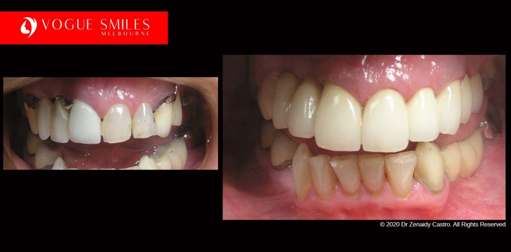 Cosmetic Dentistry Treatment Results Gallery, closeup photos porcelain veneers before and after Melbourne, Affordable Dental Veneers Before and After Melbourne close-up, Vogue Smiles Dental Dentistry Melbourne Studios Clinic Practice