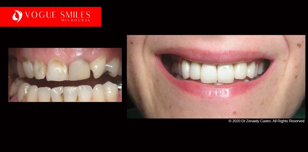 Cosmetic Dentistry Treatment Results Gallery, closeup photos porcelain veneers before and after Melbourne, Affordable Dental Veneers Before and After Melbourne close-up, Vogue Smiles Dental Dentistry Melbourne Studios Clinic Practice