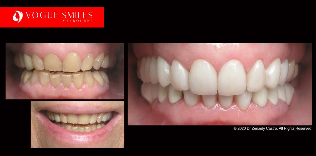 Full Mouth Reconstruction Before and After