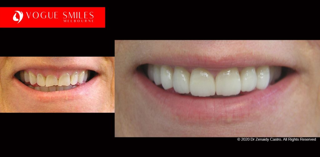 Cosmetic Dentistry Treatment Results Gallery, closeup photos porcelain veneers before and after Melbourne, Affordable Dental Veneers Before and After Melbourne close-up, Vogue Smiles Dental Dentistry Melbourne Studios Clinic Practice