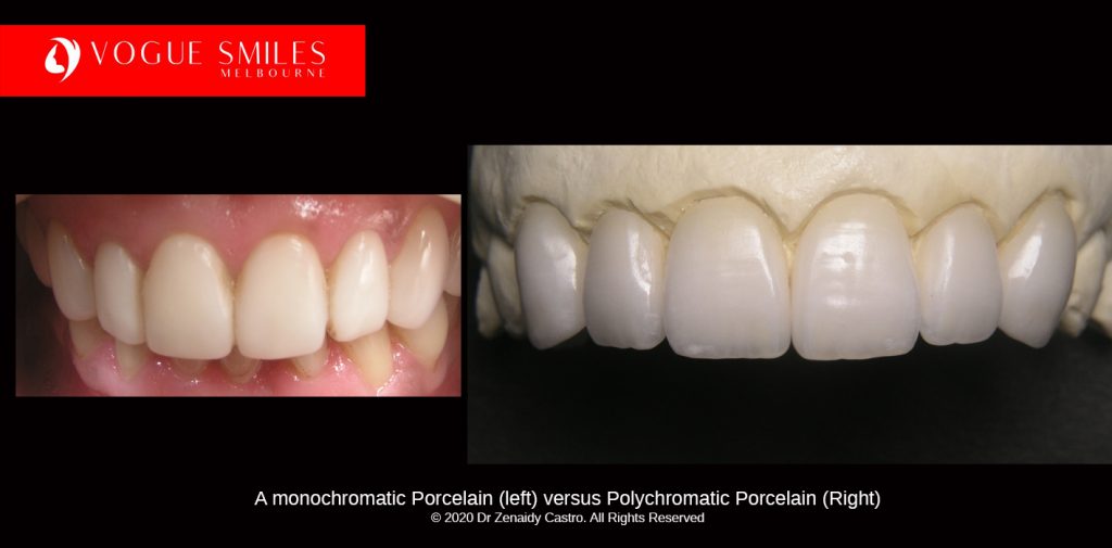 Cosmetic Dentistry Treatment Results Gallery, closeup photos porcelain veneers before and after Melbourne, Affordable Dental Veneers Before and After Melbourne close-up, Vogue Smiles Dental Dentistry Melbourne Studios Clinic Practice