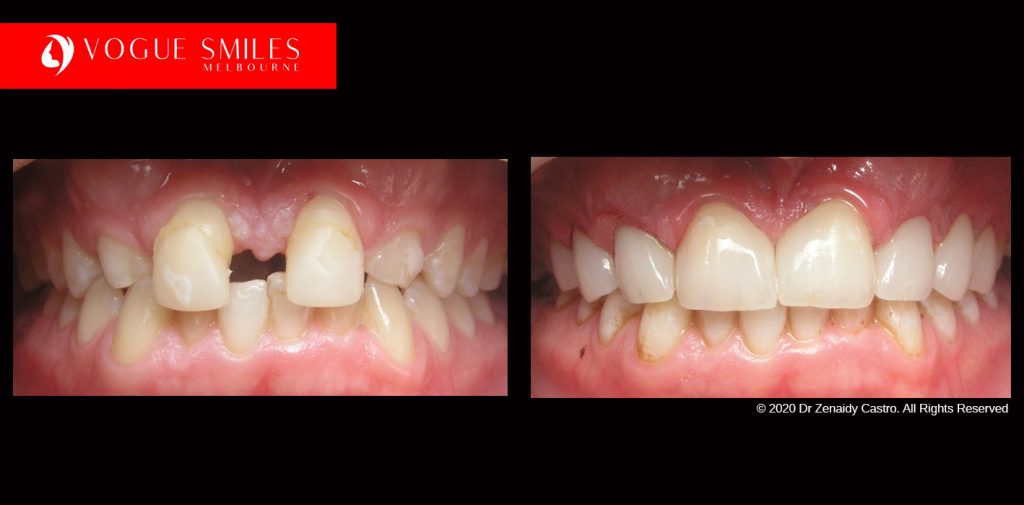 Full Mouth Reconstruction Before and After