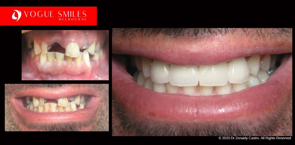 Full Mouth Reconstruction Before and After