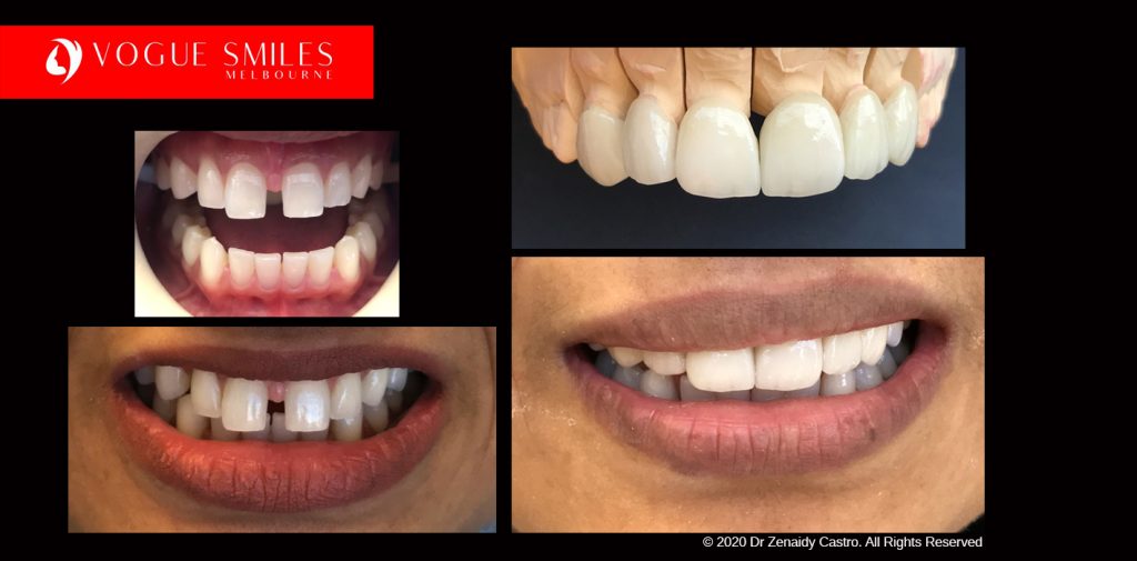 Full Mouth Reconstruction Before and After