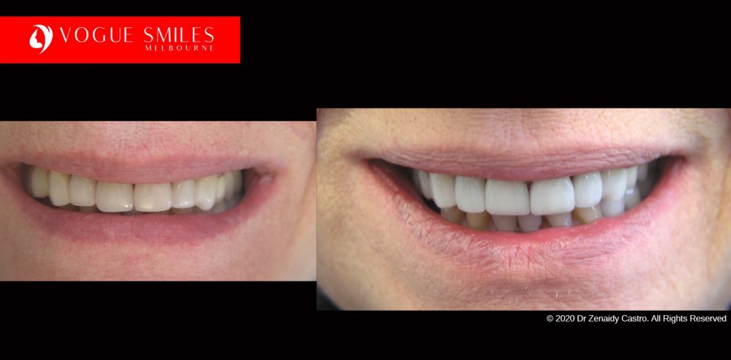 Cosmetic Dentistry Treatment Results Gallery, closeup photos porcelain veneers before and after Melbourne, Affordable Dental Veneers Before and After Melbourne close-up, Vogue Smiles Dental Dentistry Melbourne Studios Clinic Practice