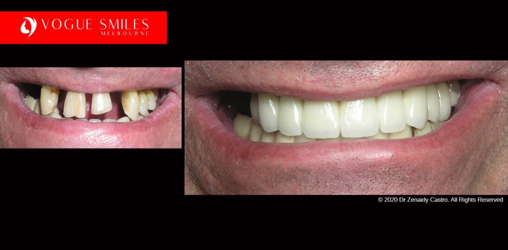 Full Mouth Reconstructions Melbourne Before and After