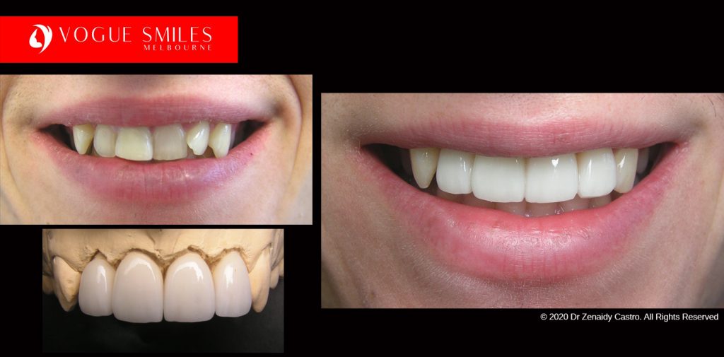 Cosmetic Dentistry Treatment Results Gallery, closeup photos porcelain veneers before and after Melbourne, Affordable Dental Veneers Before and After Melbourne close-up, Vogue Smiles Dental Dentistry Melbourne Studios Clinic Practice