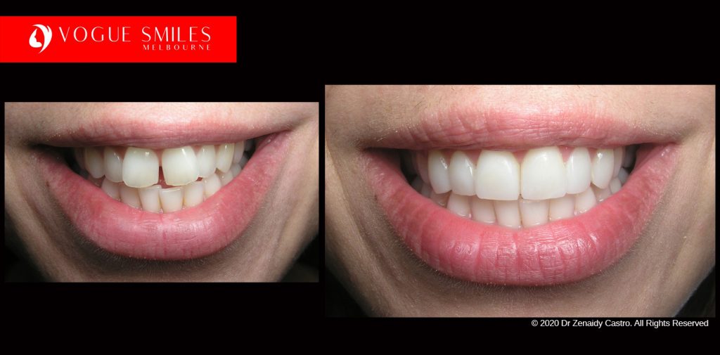 Cosmetic Dentistry Treatment Results Gallery closeup photos - Vogue Smiles Dental Dentistry Melbourne Studios Clinic Practice