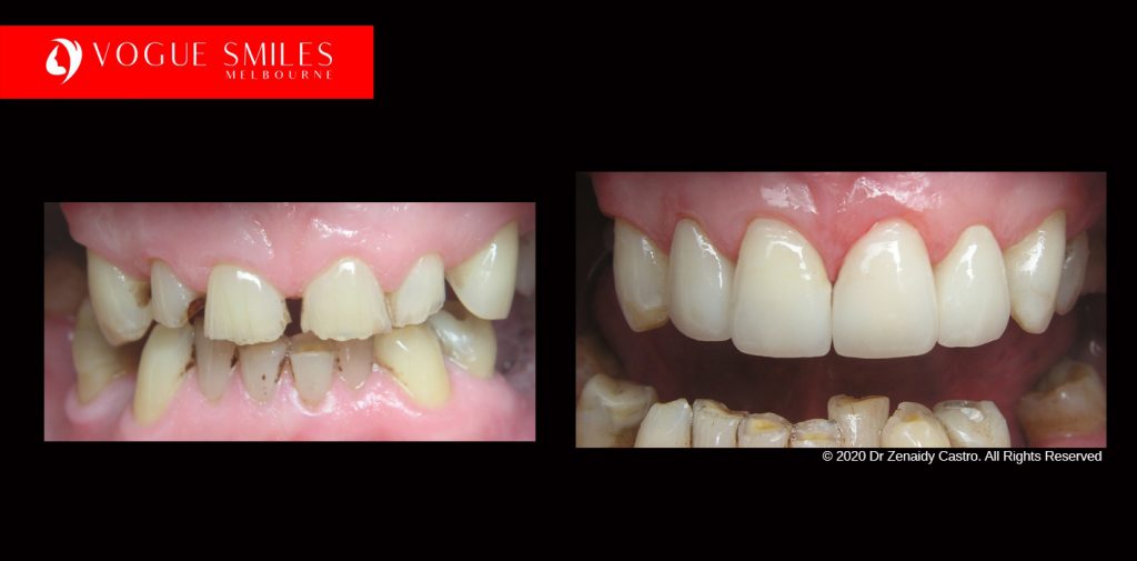 Full Mouth Reconstruction Before and After