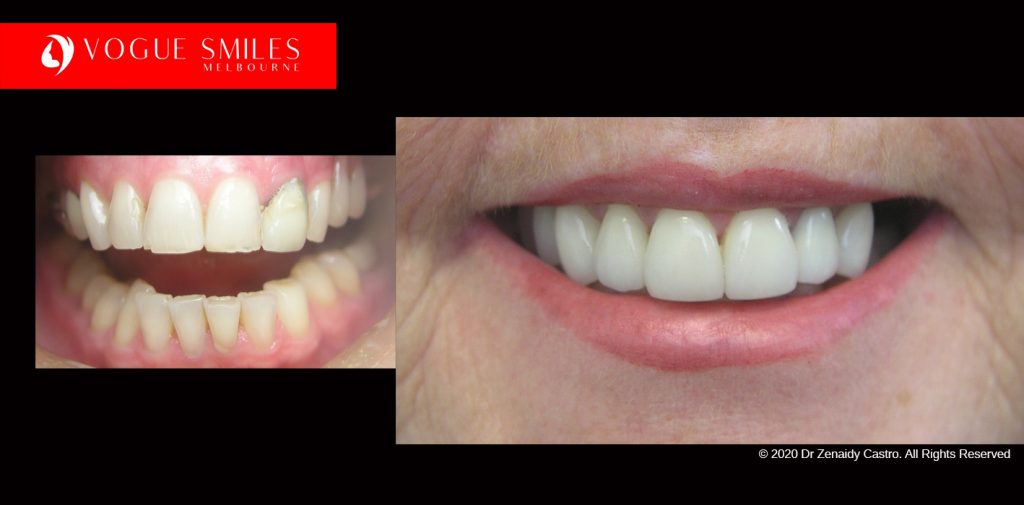 Cosmetic Dentistry Treatment Results Gallery closeup photos - Vogue Smiles Dental Dentistry Melbourne Studios Clinic Practice