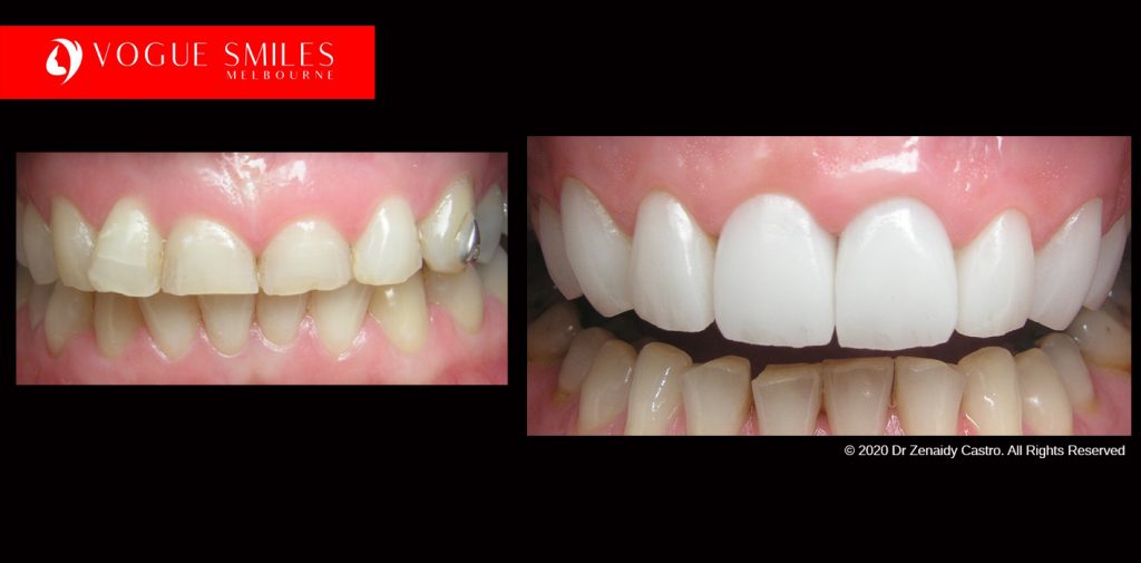 Cosmetic Dentistry Treatment Results Gallery closeup photos - Vogue Smiles Dental Dentistry Melbourne Studios Clinic Practice