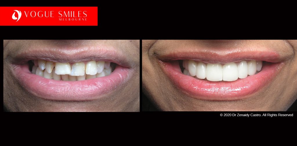 Full Mouth Reconstruction Before and After