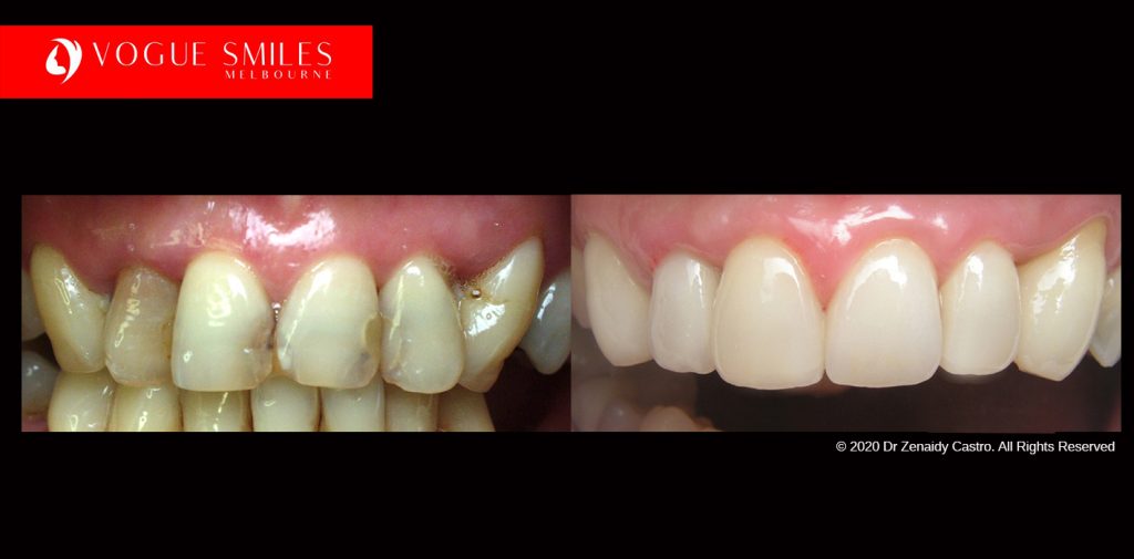 Cosmetic Dentistry Treatment Results Gallery closeup photos - Vogue Smiles Dental Dentistry Melbourne Studios Clinic Practice