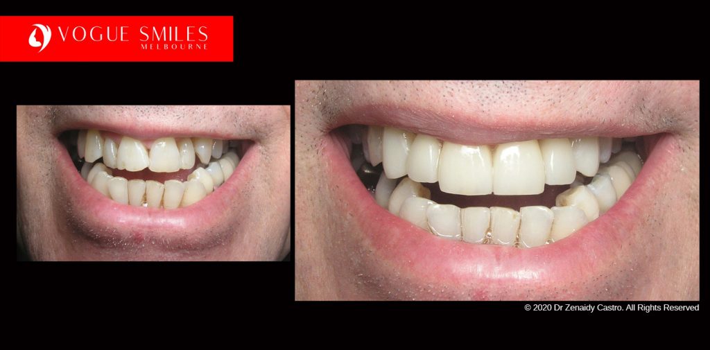 Cosmetic Dentistry Treatment Results Gallery closeup photos - Vogue Smiles Dental Dentistry Melbourne Studios Clinic Practice