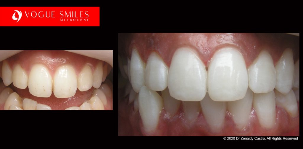 Cosmetic Dentistry Treatment Results Gallery closeup photos - Vogue Smiles Dental Dentistry Melbourne Studios Clinic Practice