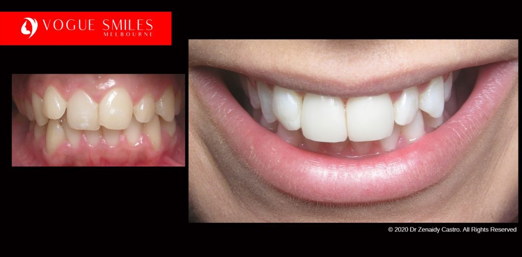 Cosmetic Dentistry Treatment Results Gallery closeup photos - Vogue Smiles Dental Dentistry Melbourne Studios Clinic Practice