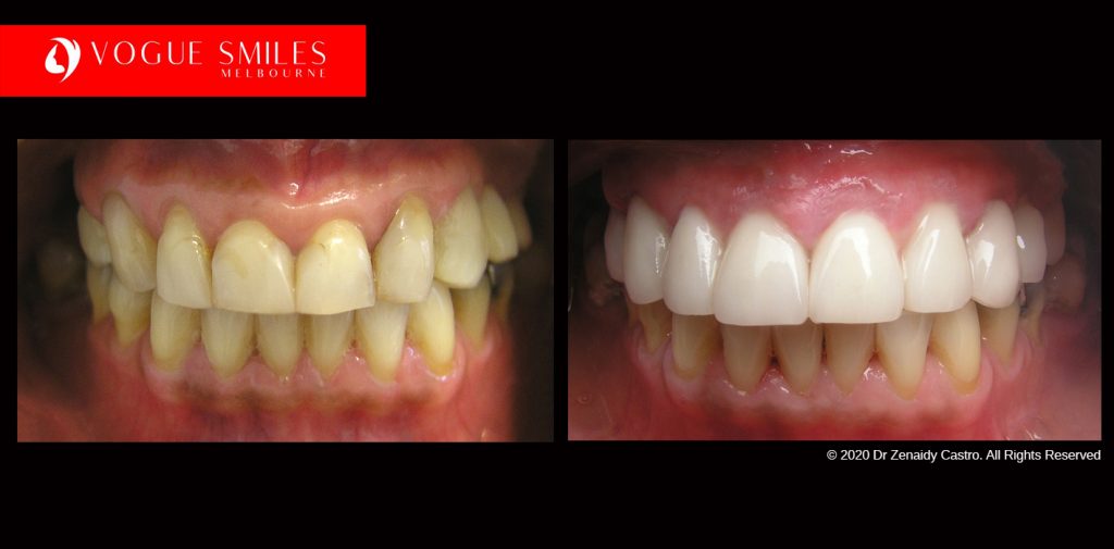 Full Mouth Reconstruction Before and After