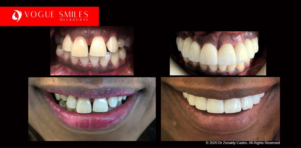 Full Mouth Reconstructions Melbourne Before and After