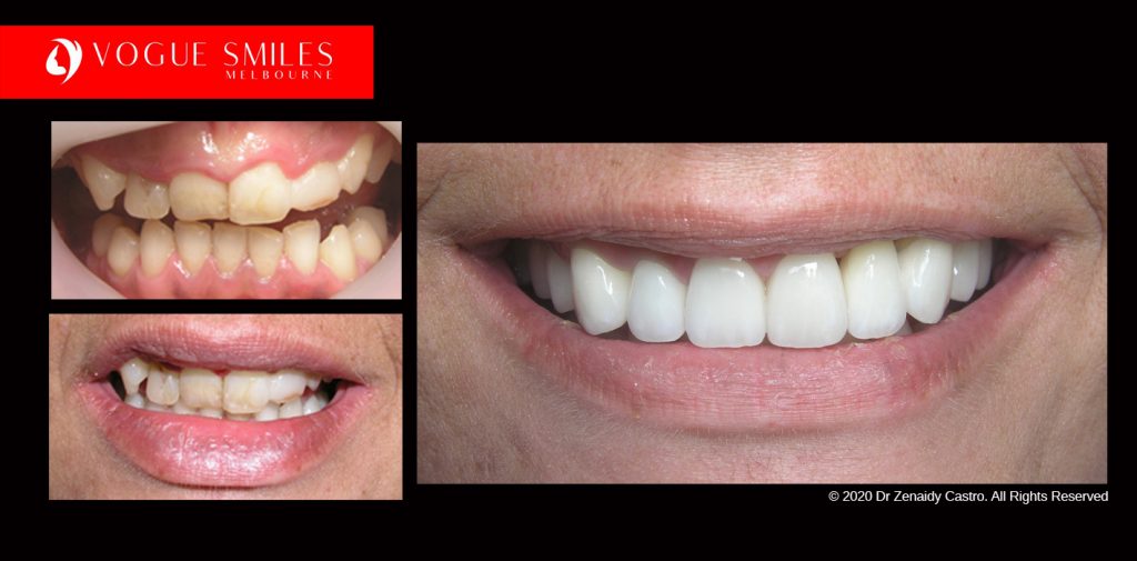 Full Mouth Reconstructions Melbourne Before and After