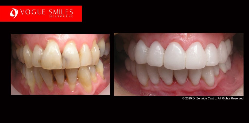 Full Mouth Reconstruction Before and After