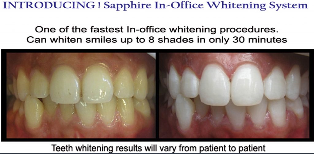 Tooth Whitening Melbourne | Laser Tooth Whitening teeth | whitening cost melbourne | Dental Clinic -surgery-office near me Melbourne CBD | Dentist near me | VOGUE SMILES MELBOURNE