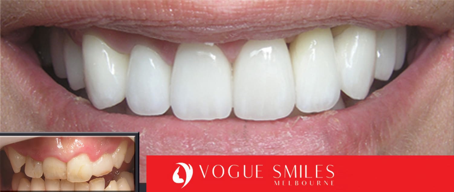 Tooth Whitening Melbourne | Laser Tooth Whitening teeth | whitening cost melbourne | Dental Clinic -surgery-office near me Melbourne CBD | Dentist near me | VOGUE SMILES MELBOURNE