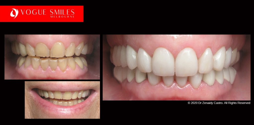 Tooth Whitening Melbourne | Laser Tooth Whitening teeth | whitening cost melbourne | Dental Clinic -surgery-office near me Melbourne CBD | Dentist near me | VOGUE SMILES MELBOURNE