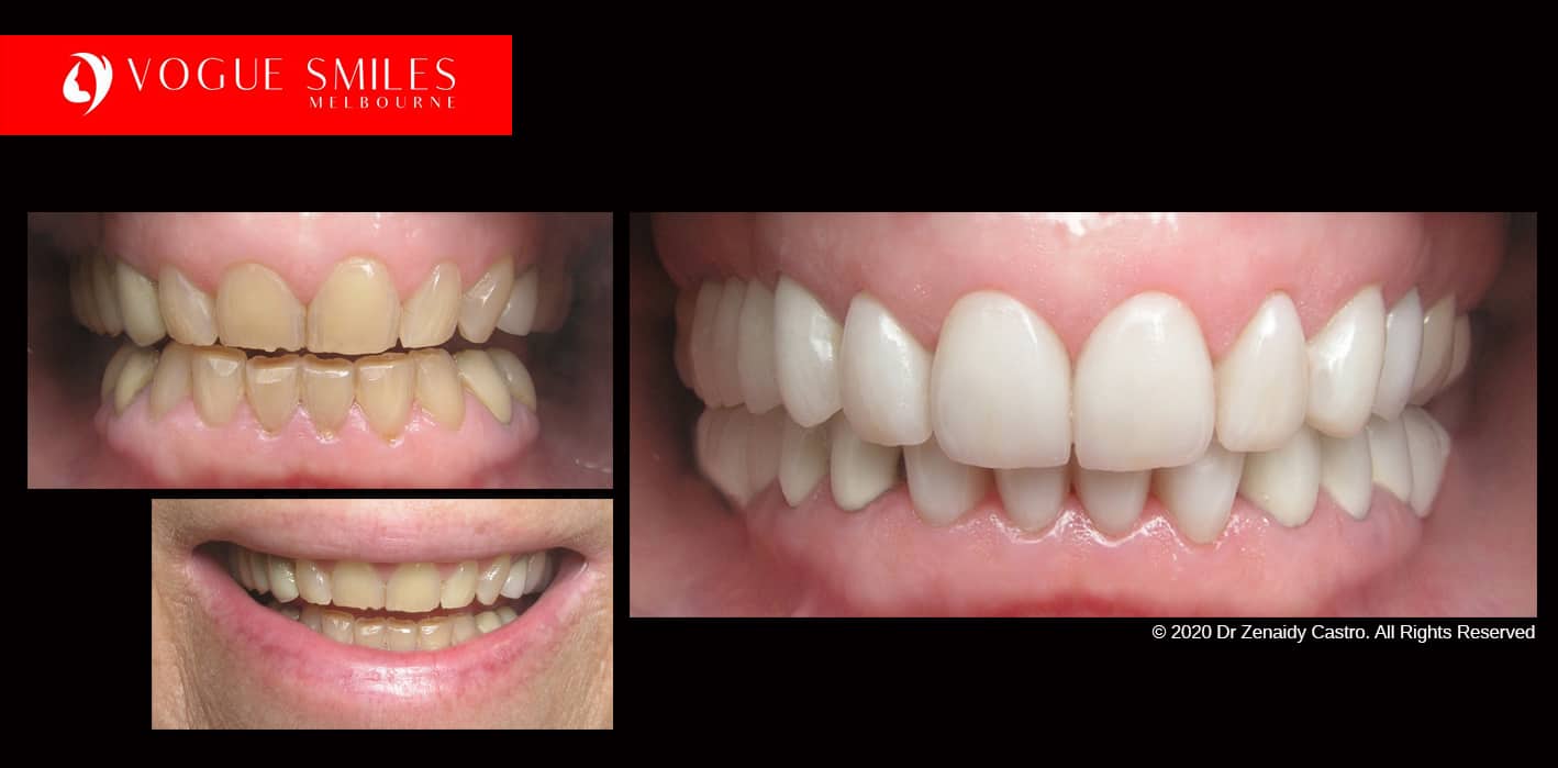 Tooth Whitening Melbourne | Laser Tooth Whitening teeth | whitening cost melbourne | Dental Clinic -surgery-office near me Melbourne CBD | Dentist near me | VOGUE SMILES MELBOURNE