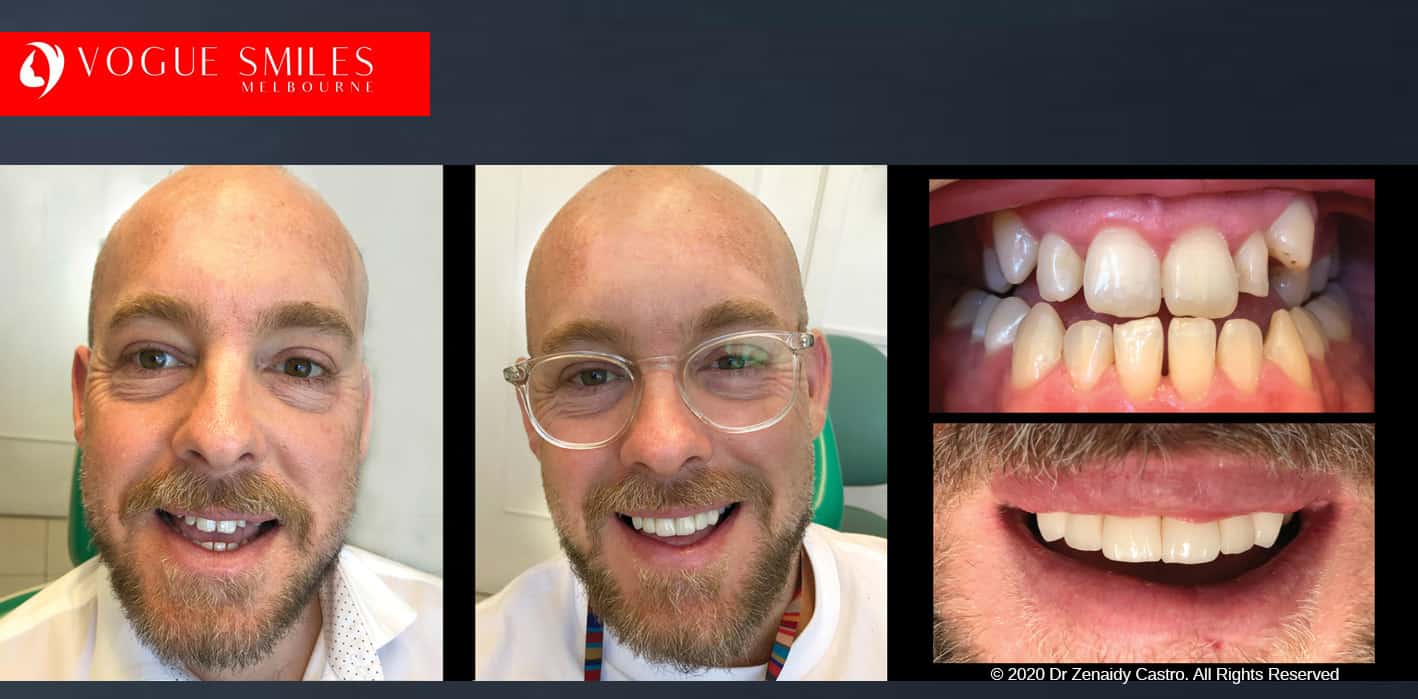 Crooked Teeth Before and After Gallery Melbourne CBD