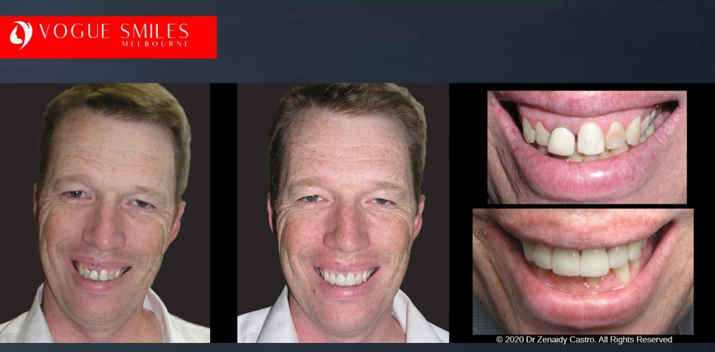 Crooked Teeth Before and After Gallery Melbourne CBD - Instantly Straighten Teeth - fix crooked teeth without braces