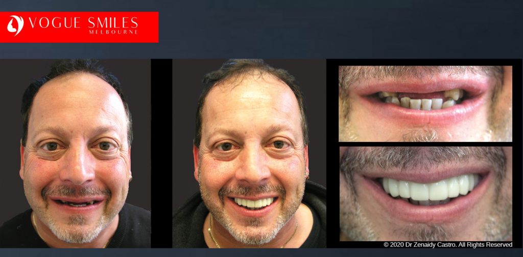 Before and After Photos Snap on Smile in Melbourne - Affordable Cosmetic Dentistry Alternative MELBOURNE AUSTRALIA