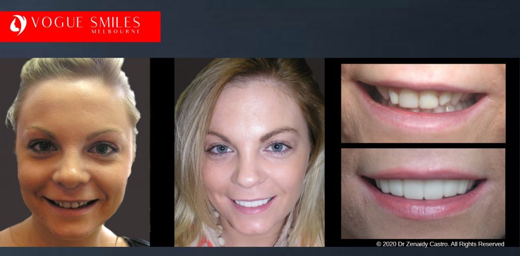 Before and After Photos Snap on Smile in Melbourne - Affordable Cosmetic Dentistry Alternative MELBOURNE AUSTRALIA