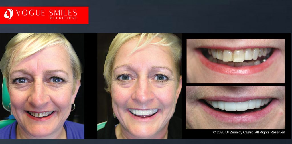 Before and After Photos Snap on Smile in Melbourne - Affordable Cosmetic Dentistry Alternative MELBOURNE AUSTRALIA