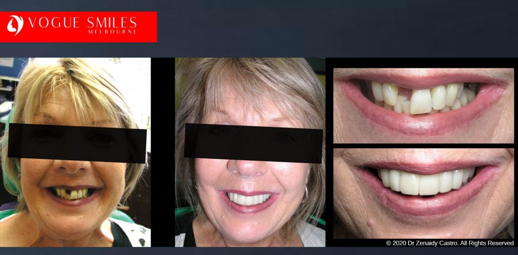 Before and After Photos Snap on Smile in Melbourne - Affordable Cosmetic Dentistry Alternative MELBOURNE AUSTRALIA