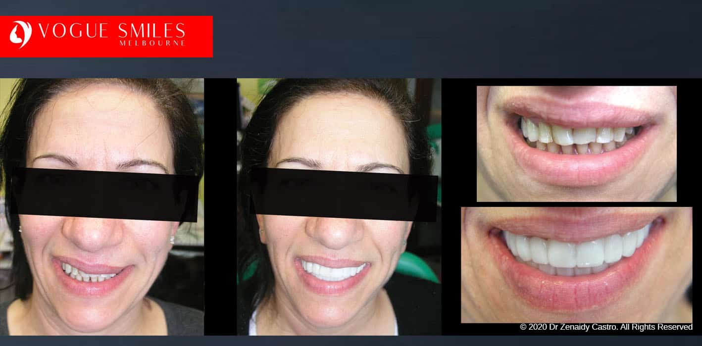 Affordable Cosmetic Dentistry Before & After - SNAP ON SMILE MELBOURNE AUSTRALIA
