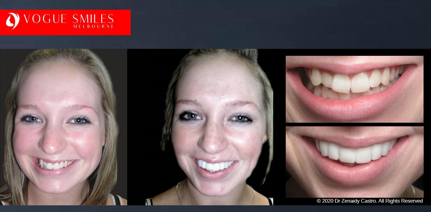 Affordable Cosmetic Dentistry Before & After - SNAP ON SMILE MELBOURNE AUSTRALIA