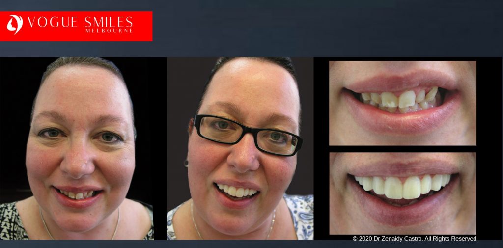 Before and After Photos Snap on Smile in Melbourne - Affordable Cosmetic Dentistry Alternative MELBOURNE AUSTRALIA