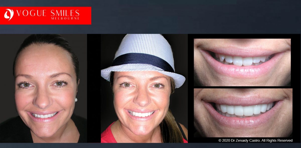 Before and After Photos Snap on Smile in Melbourne - Affordable Cosmetic Dentistry Alternative MELBOURNE AUSTRALIA