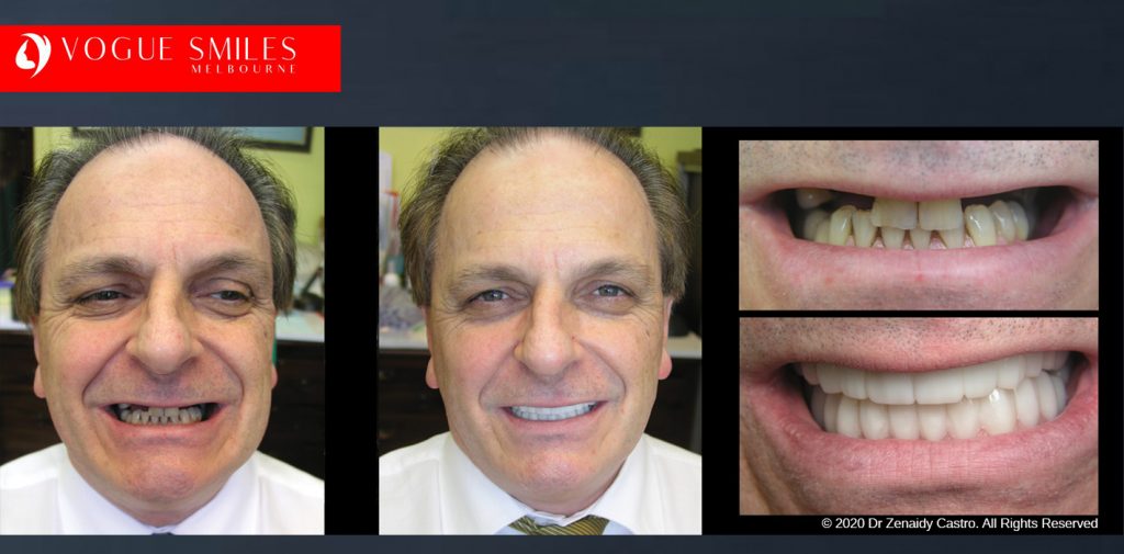 Before and After Photos Snap on Smile in Melbourne - Affordable Cosmetic Dentistry Alternative MELBOURNE AUSTRALIA