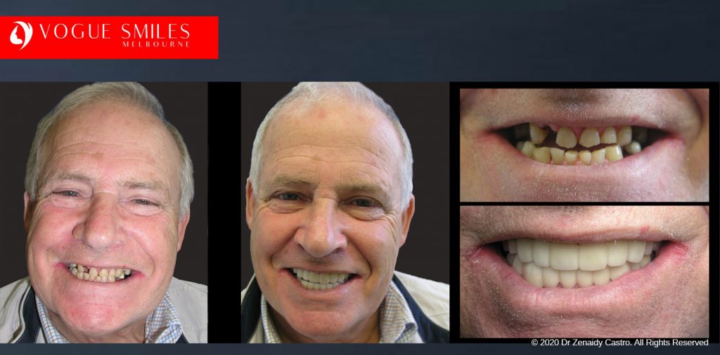 Before and After Photos Snap on Smile in Melbourne - Affordable Cosmetic Dentistry Alternative MELBOURNE AUSTRALIA